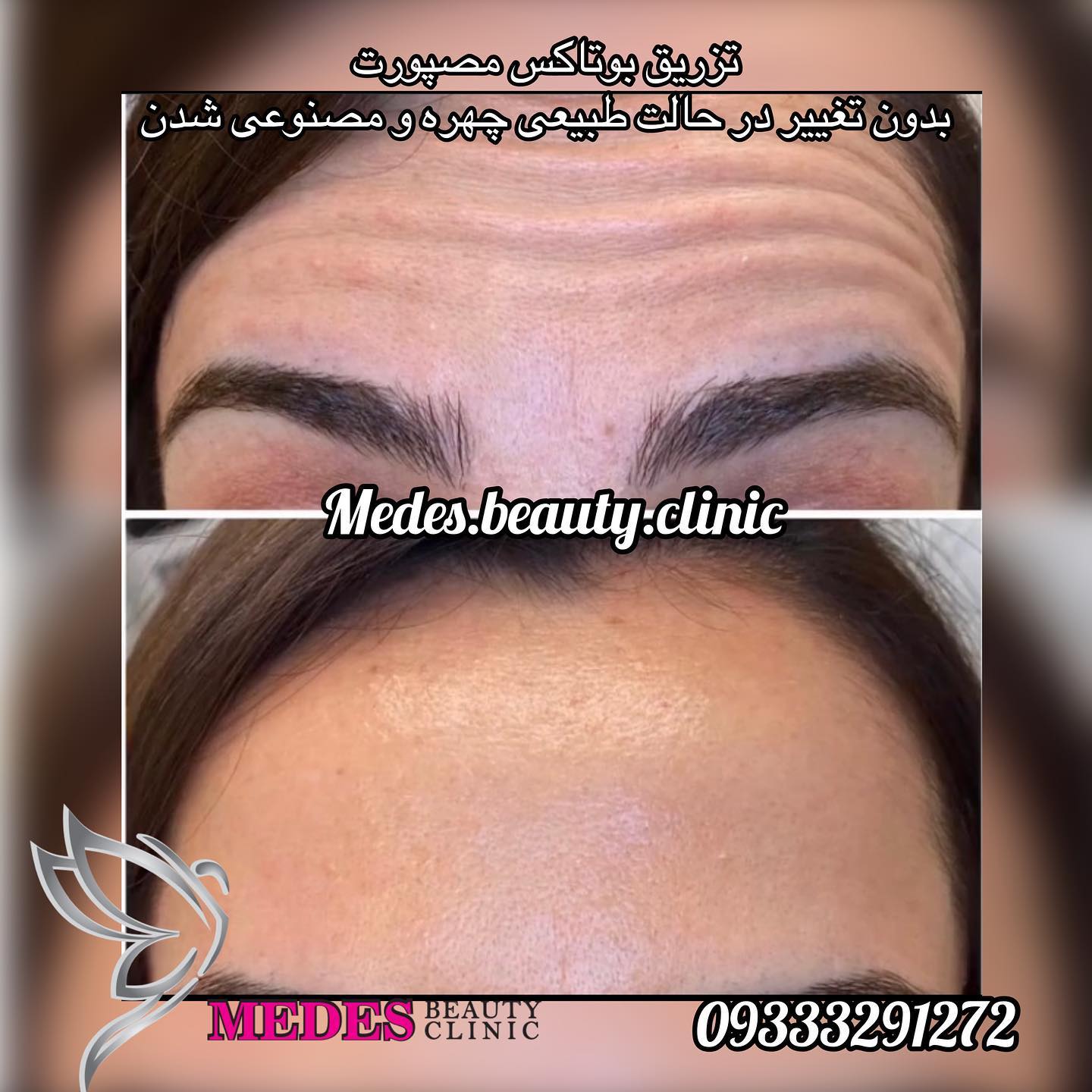 گالری تزریق بوتاکس